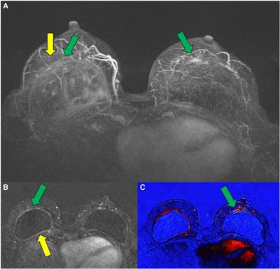 Breast silicone implants’ pericapsular impairment: current underdiagnosed status